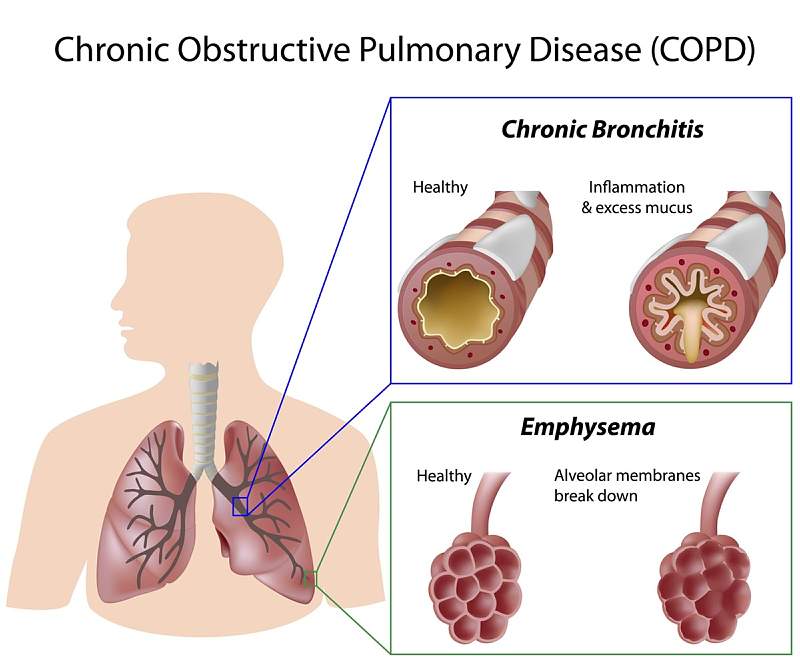 Chronic obstructive plumory disease