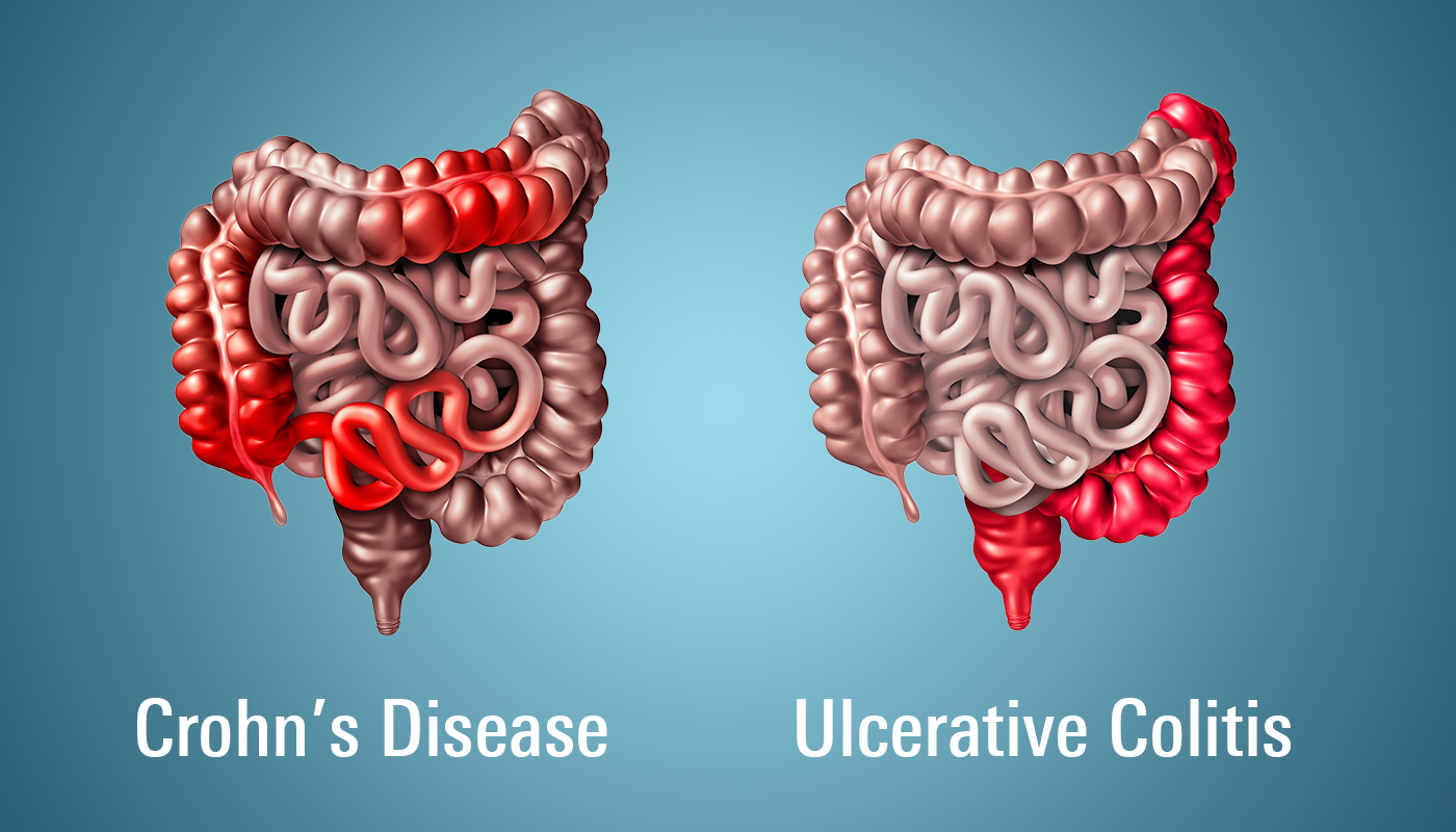 Types of ibd