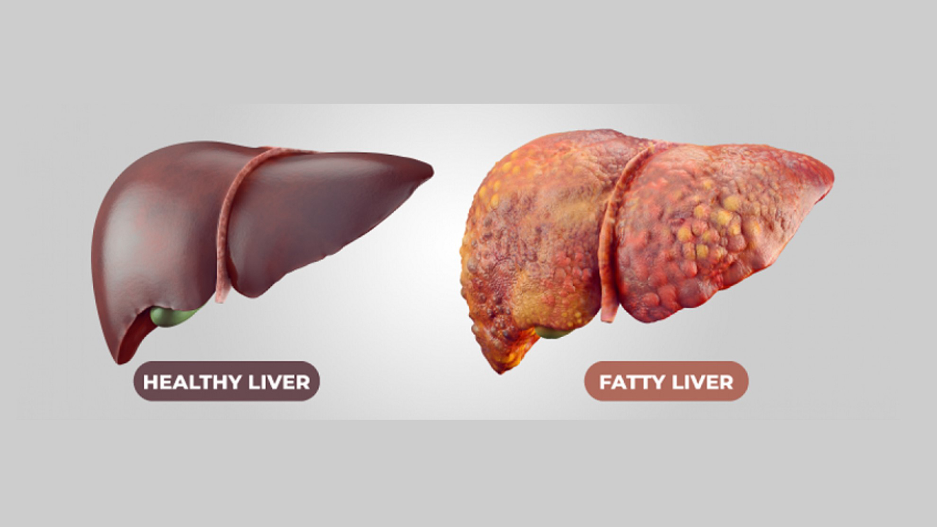 fatty liver