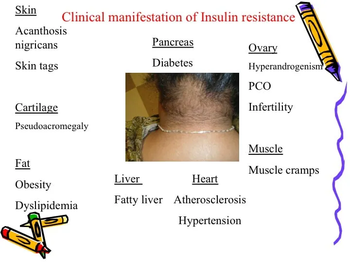 Symptoms of Insulin Resistance