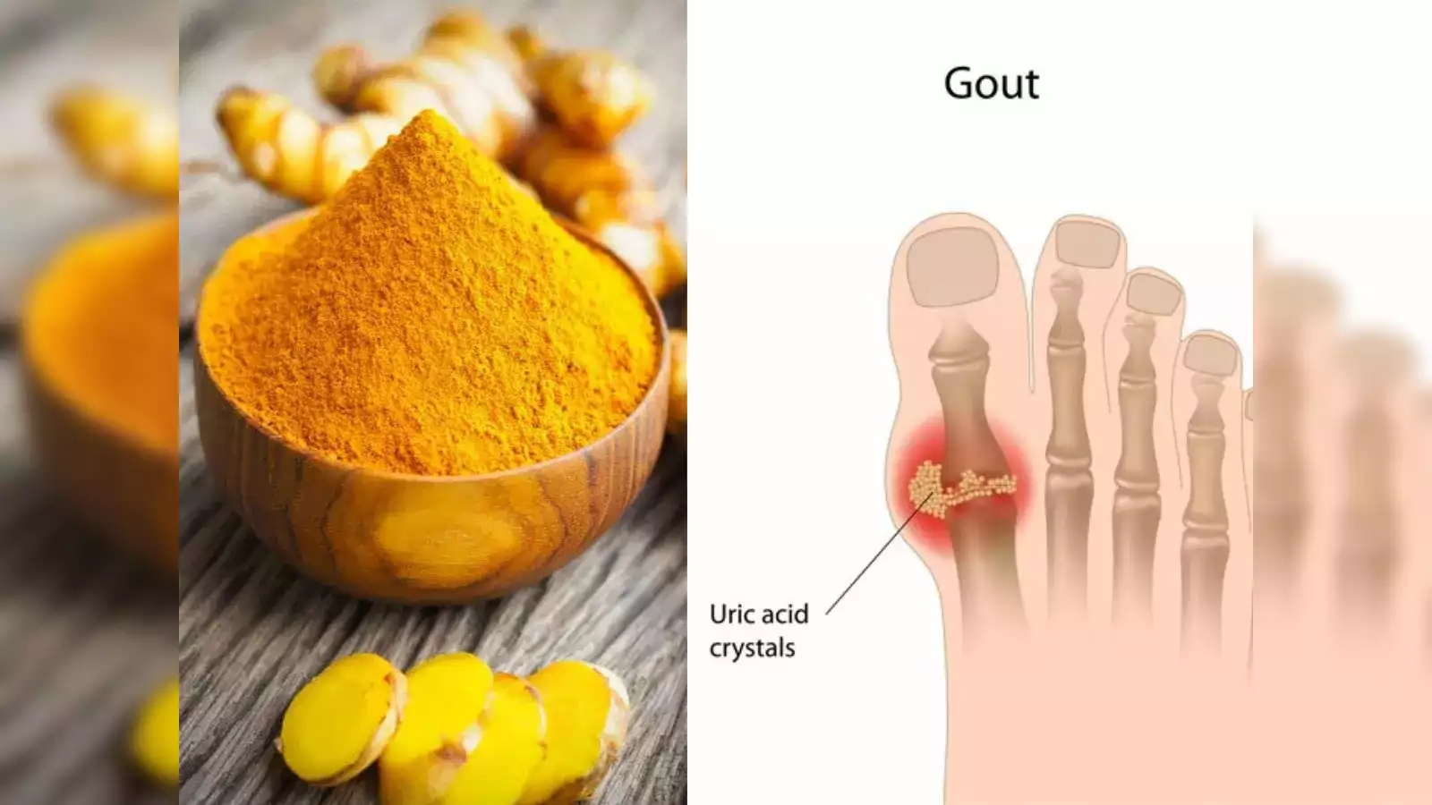 Turmeric for Gout