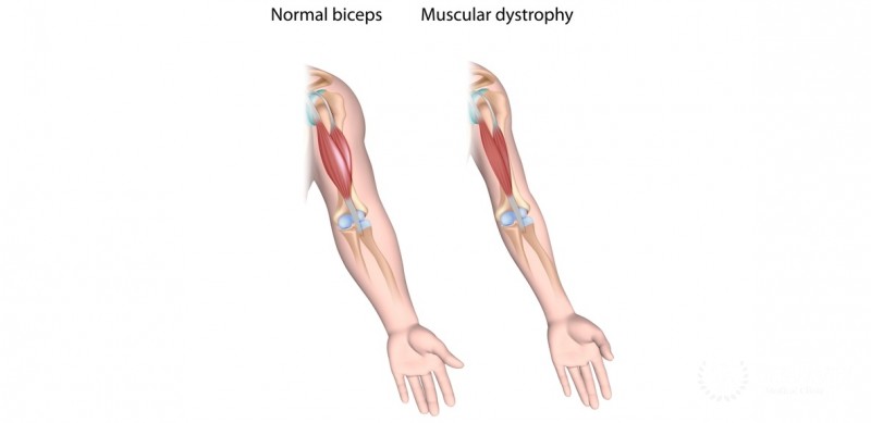 normal decline of muscles