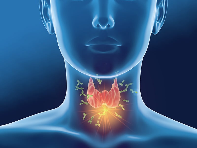 Hashimoto’s Thyroiditis,