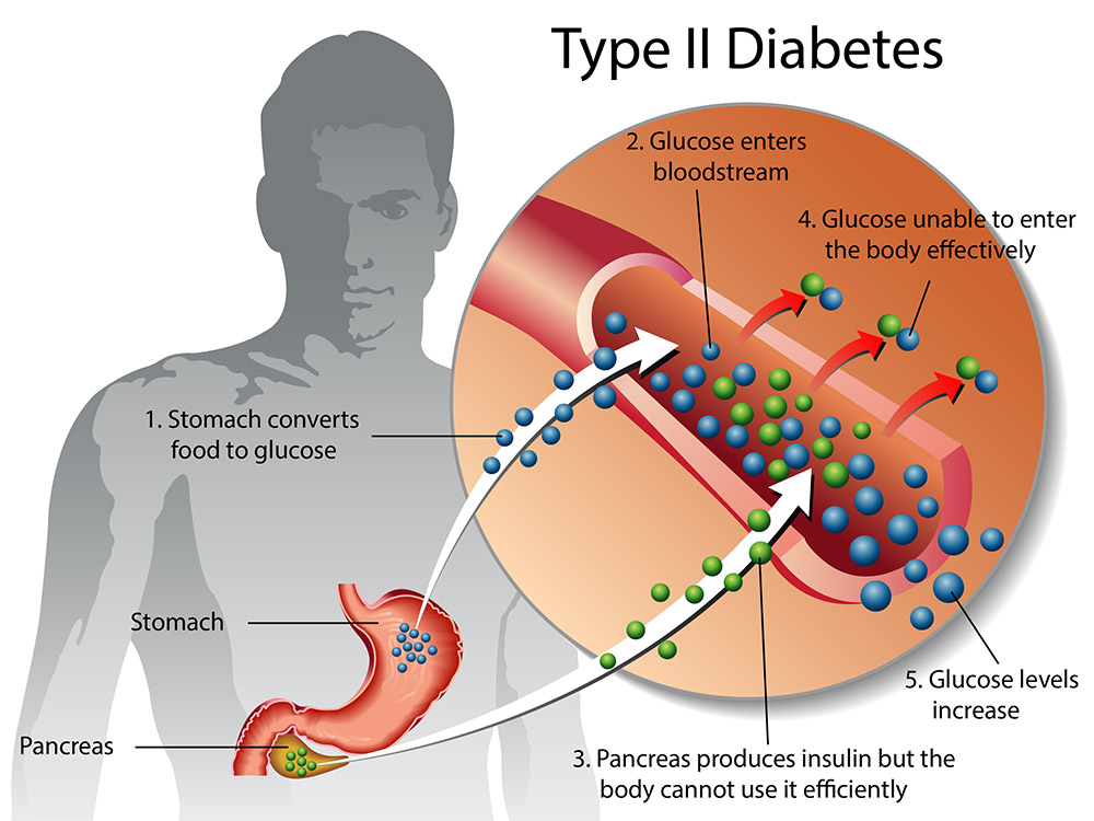 What happens in Type-II Diabetes Mellitus?