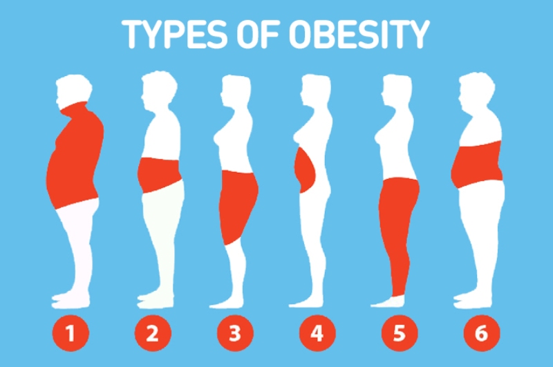 What is obesity? types of obesity