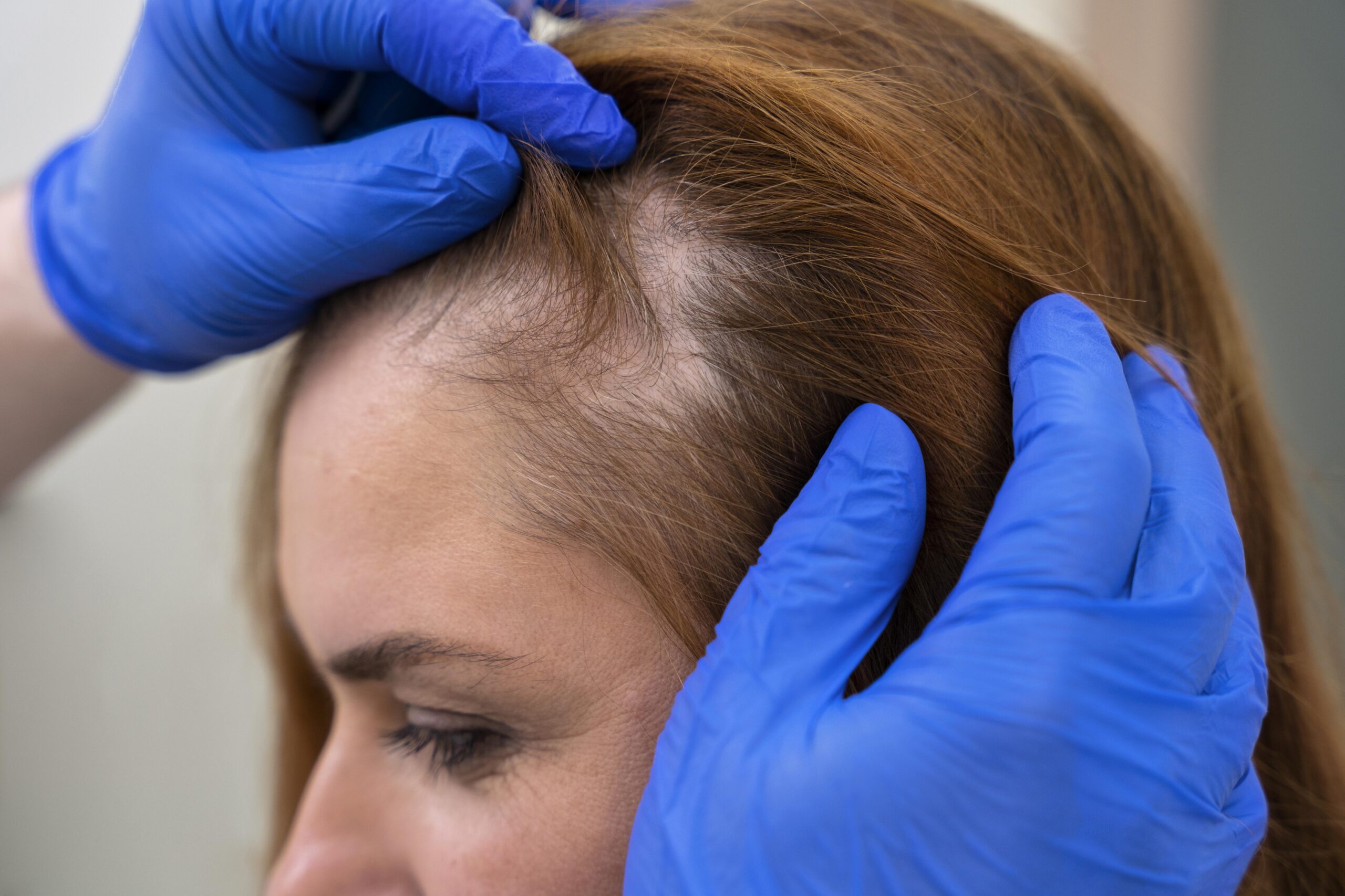 hairfall, symptom of hypothyroidism 