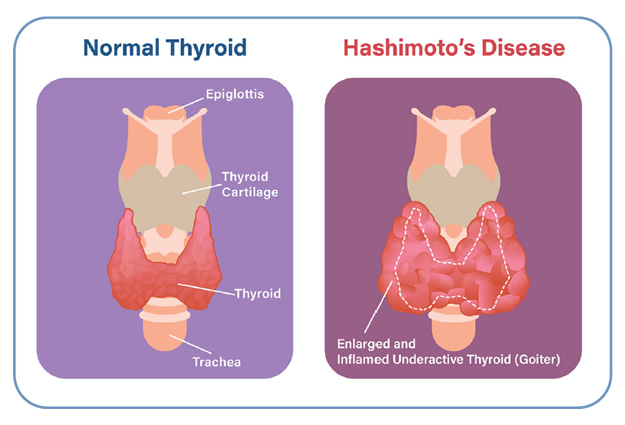 hashimoto's thyroiditis