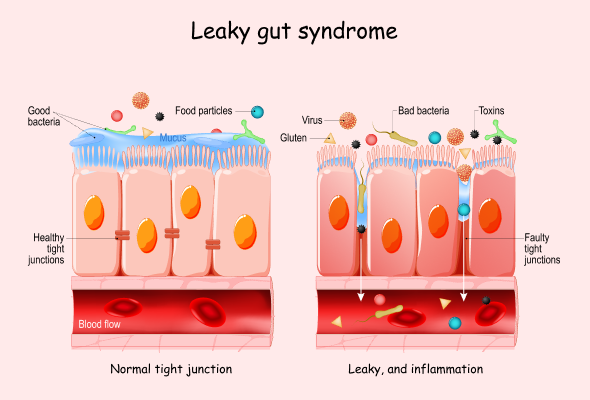 What is Leaky Gut Syndrome?